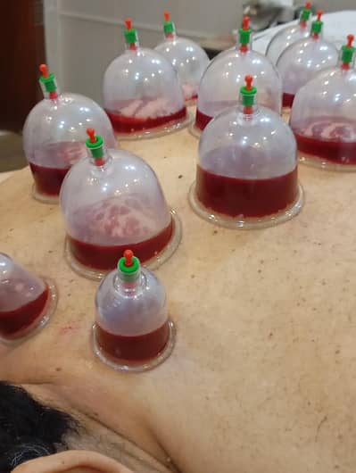 Hijama(cupping therapy) for Fateh Garh , Taj Bagh , Darogewala