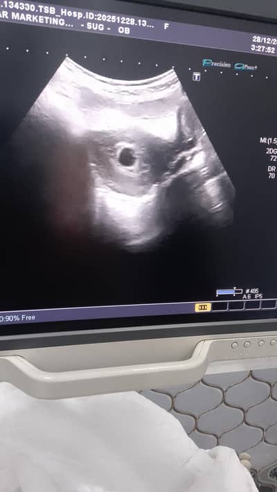 color Doppler ultrasound