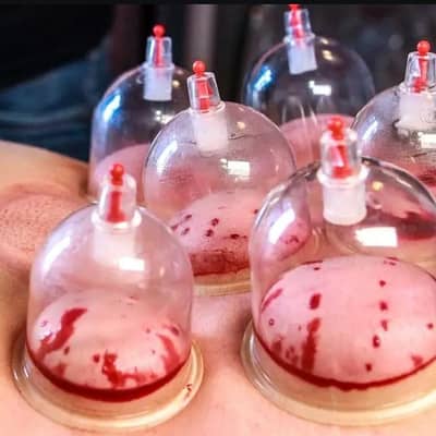 Hijama ( cupping) therapy free home session