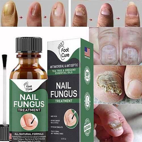 Fast Nail Fungal Treatments Nail Repair Essences Serum Care Treatments Foot Nail Fungus Removal