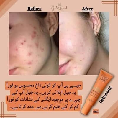 pure skin sos blemish gel