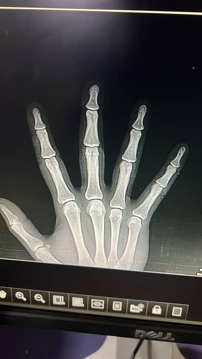 100 MA x_ray mashine