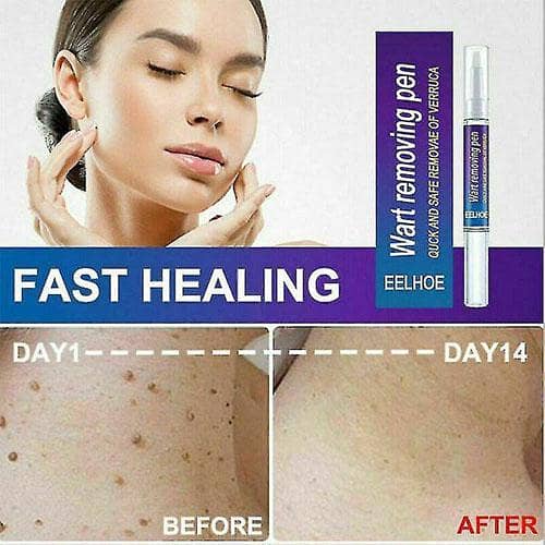 Removal Of Warts Liquid Pen Woman Skin Care Removing Against Moles Patch Remove Black Dot Emulsion