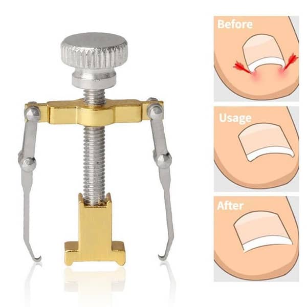 Ingrown Toenail Corrector Straightning Clip Pedicure foot nail care tools Stainles steel Pedicure treatment tool Onyxis Corrector