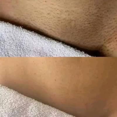 IPL Permanent Laser Hair Removal Device | Fast Results | High Quality