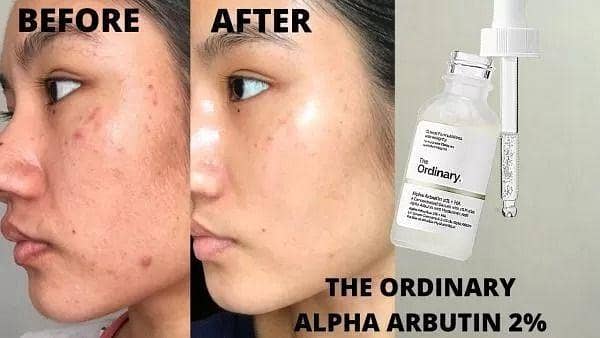 The Ordinary Alpha Arbutin 2% + HA Serum* Specifically designed to target uneven skin tone and visibly improve pigmentation 30ml