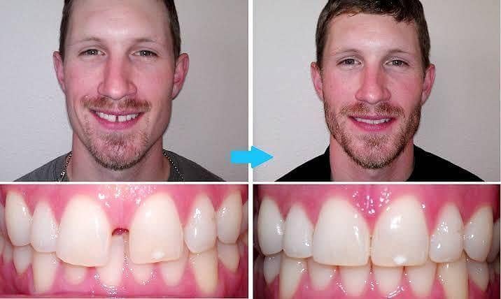 Teeth Gap Filler for Teeth