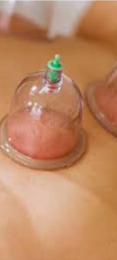free hijama