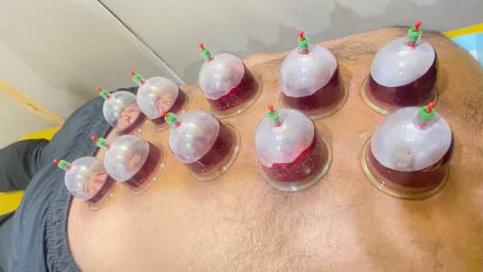 Physiotherapy & hijama therapy  Home Services.