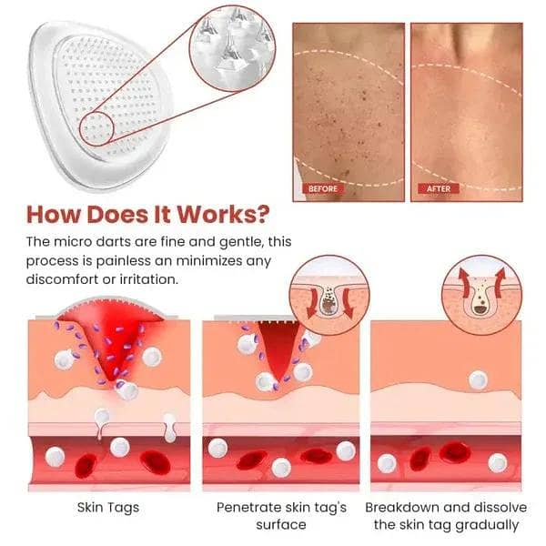 DermaSmooth Skin Tag Remover Patch 2