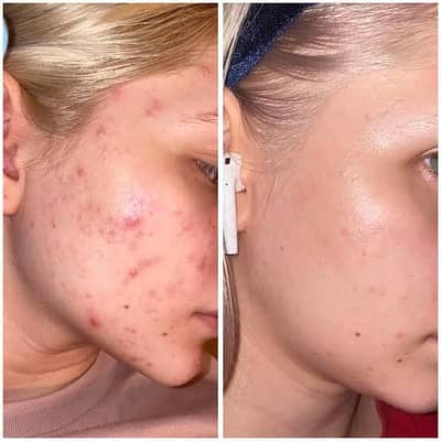 Acne Control Face Serum | Anti Acne & Blemish Removal Serum .