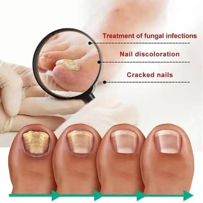 Nail Fungus Treatment Serum