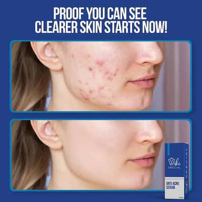 Anti Acne serum