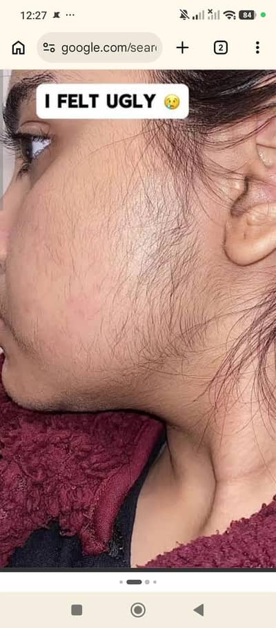 Hair Removal powder and whitening cream