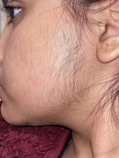 Hair Removal powder and whitening cream