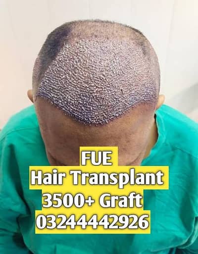 Hair Transplant Lahore Hair Loss solution Hair Again Clinic