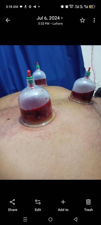 Hijama with free home session