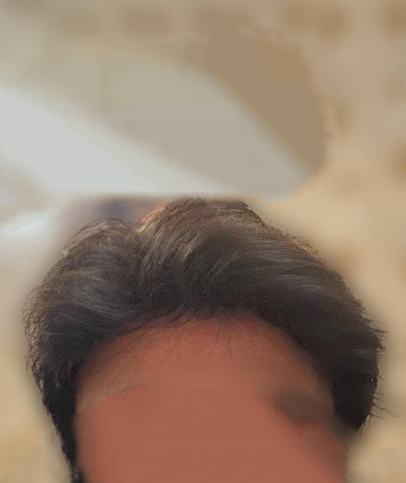 hair patch 0