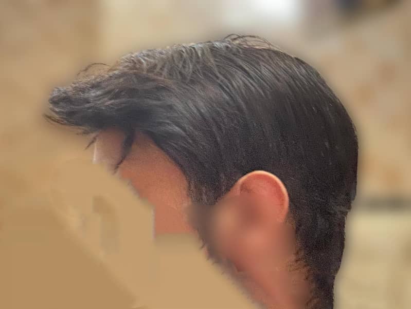 hair patch 1