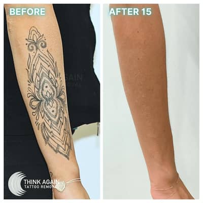 Tatto removal