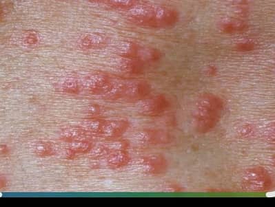 scabies -eczema-allergy- skin rash