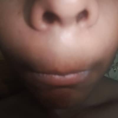 ala nasal ha