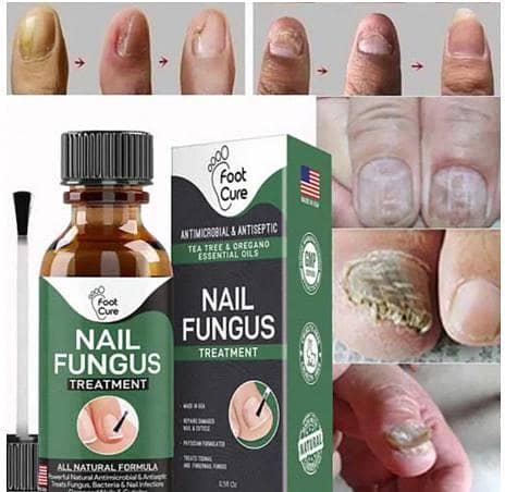 Effective Nail Repair & Fungus Treatment Serum (10ml): Stops Fungal Growth and Restores Healthy Nails. . . .