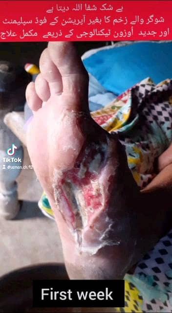 زخموں والی شوگر کا شرطیہ علاج 2