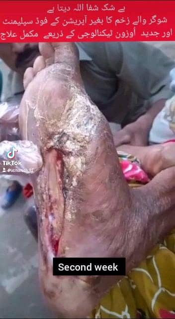 زخموں والی شوگر کا شرطیہ علاج 4