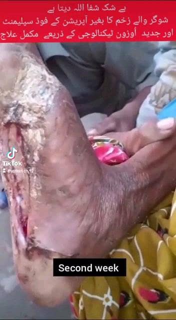 زخموں والی شوگر کا شرطیہ علاج 5