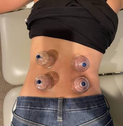 cup therapy / hijama