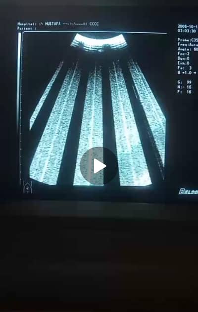 Ultrasound machine
