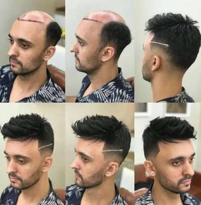 Hair transplant & asthatics