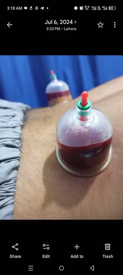 Hijama (Cupping) Free home Session