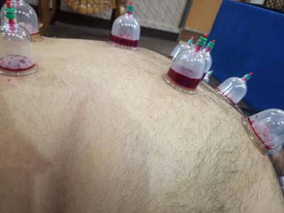 #Hijama 03434041561 free home Session