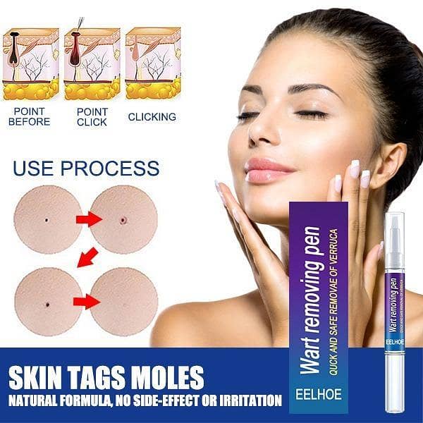 T  Wart Removal Pen Wartner Verruca Liquid Skin Care Removing Against Moles Pimple Patch Remove Black Dot Tag eye Mole Remover Gel - All Natural Way - Painless & Non Surgical - Painless