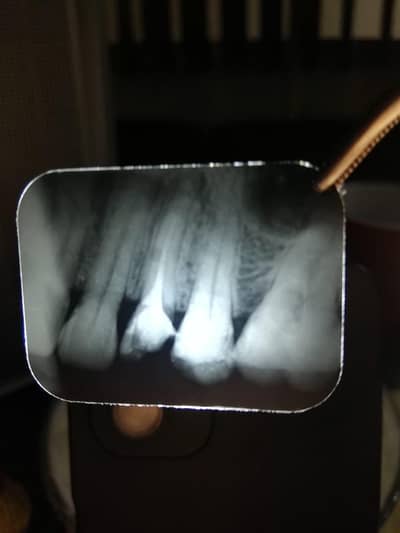 Dental xray machine